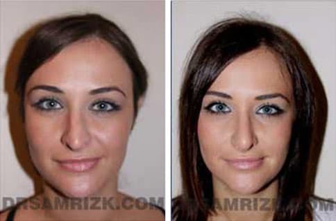 Patient face, before and after revision rhinoplasty, set 1, patient 2