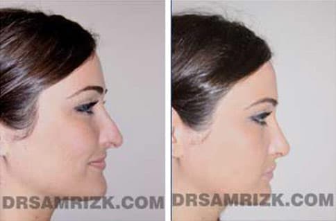 Patient face, before and after revision rhinoplasty, set 2, patient 2