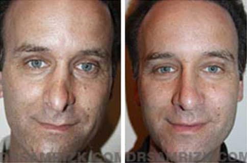 Patient face, before and after revision rhinoplasty, set 1, patient 3
