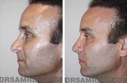 Patient face, before and after revision rhinoplasty, set 2, patient 3