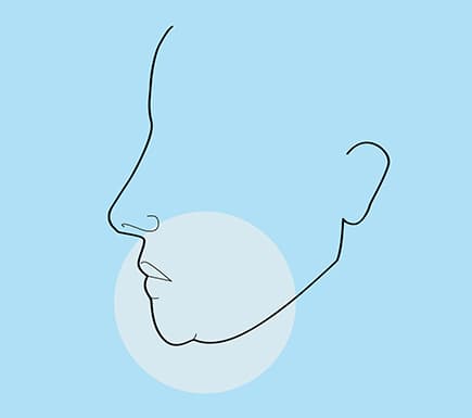 Common Face Concerns: Sagging Jowls