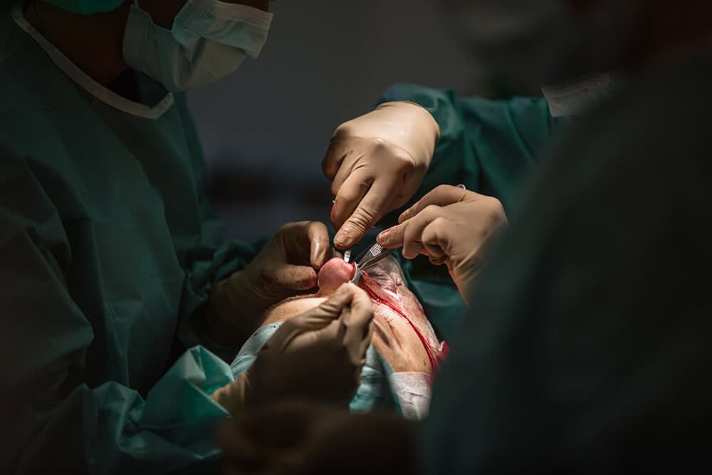 Rhinoplasty Procedure