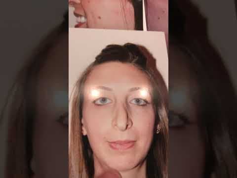 Watch Video: Revision Rhinoplasty leaves Dr. Sam Rizk’s patient happy