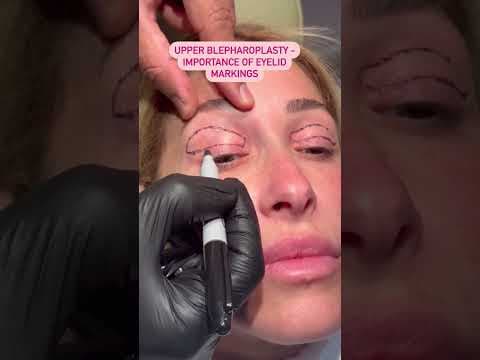 Watch Video: Female Rhinoplasty Patient Comments About Dr. Sam Rizk