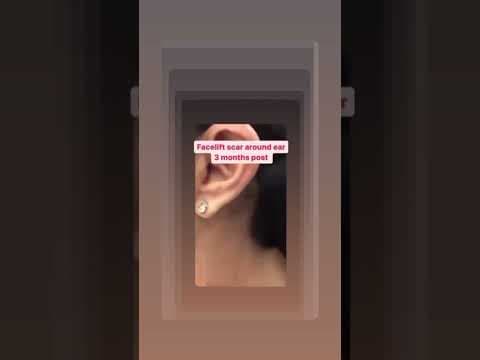 Watch Video: Dr. Rizk shares his patient’s results one week after Rhinoplasty