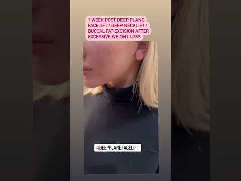 Watch Video: Dr. Rizk shares his patient’s results one week after Rhinoplasty