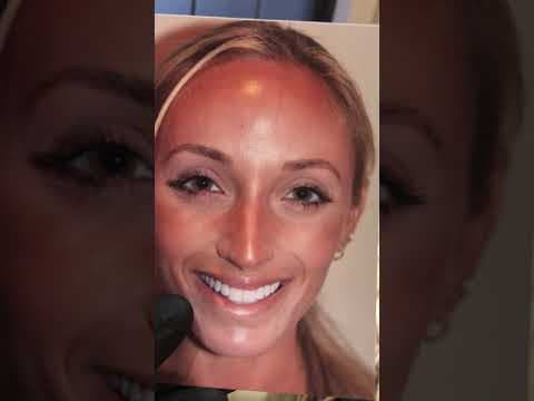 Watch Video: Patient’s easy recovery from Endonasal Rhinoplasty by Dr. Rizk